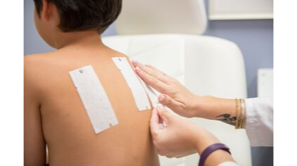 young male patient having patch test strips applied to his back