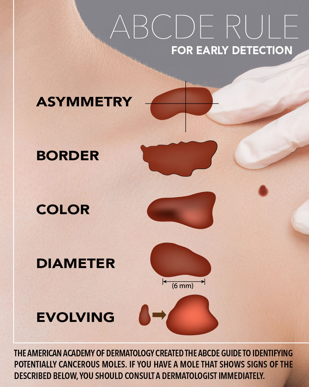 Follow the ABCDE Rule for early skin cancer detection